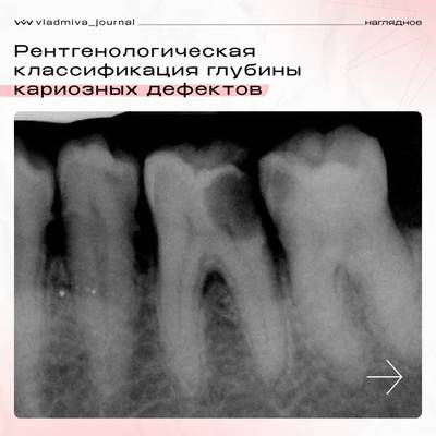 Рентгенологическая классификация глубины кариеса: клинические критерии.